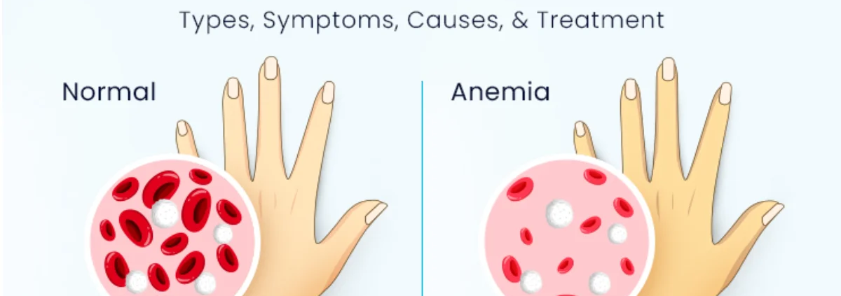 Anemia