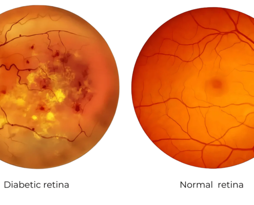 Diabetic Retinopathy