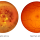 Diabetic Retinopathy