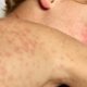 Measles