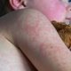 Measles
