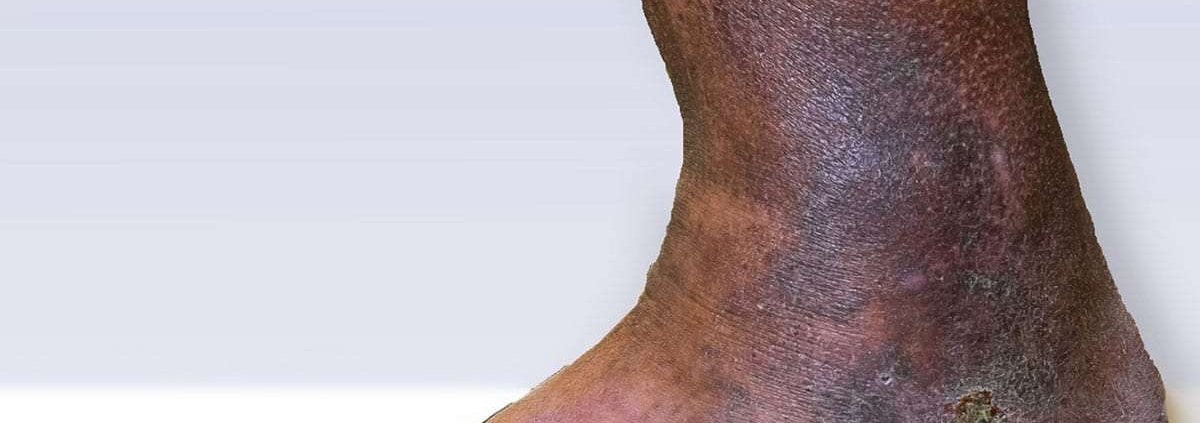 Chronic Venous Insufficiency