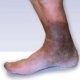 Chronic Venous Insufficiency